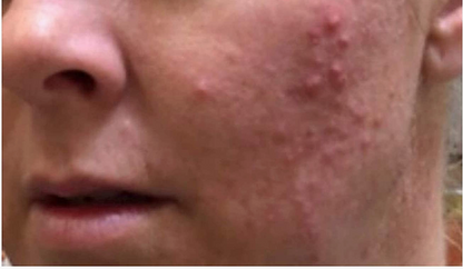 Divine Derriere Glycolic Acid 70% Professional Peel At Home