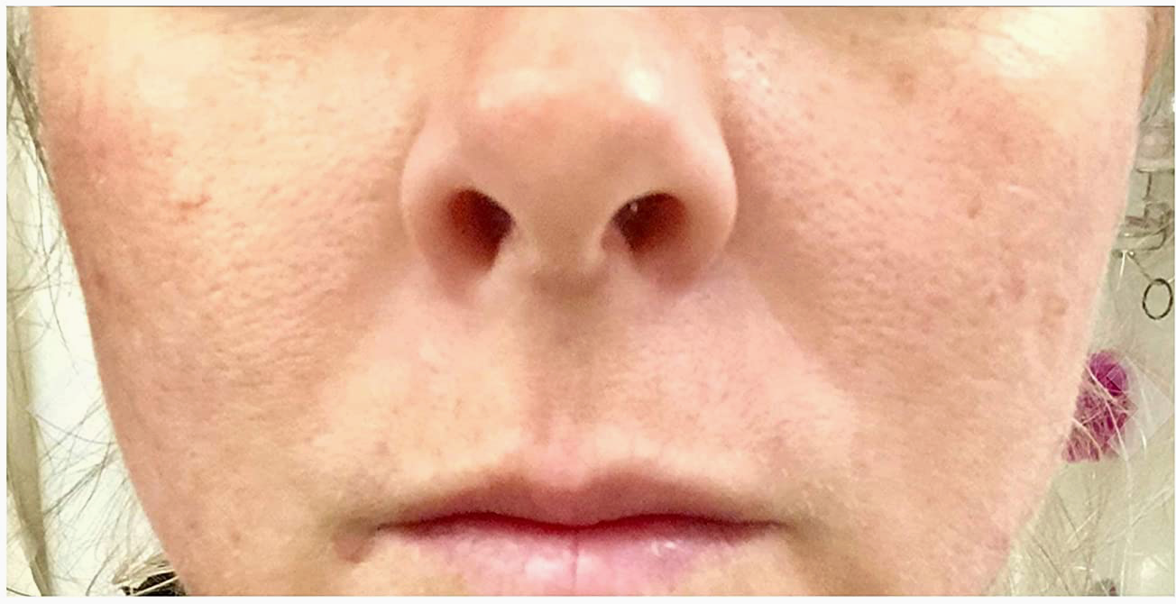 Divine Derriere Glycolic Acid 70% Professional Peel At Home